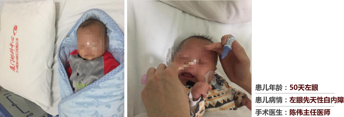 患兒年齡：50天左眼，患兒病情：左眼先天性白內(nèi)障，手術(shù)醫(yī)生：白內(nèi)障科陳偉主任醫(yī)師