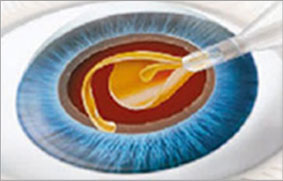 第3步:人工晶體植入