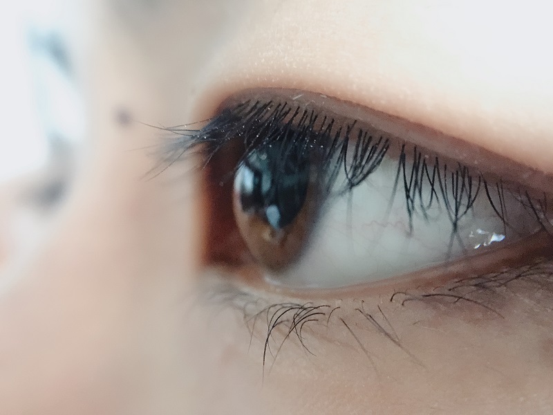 上眼皮為什么會(huì)下垂？上瞼下垂是怎么引起的？