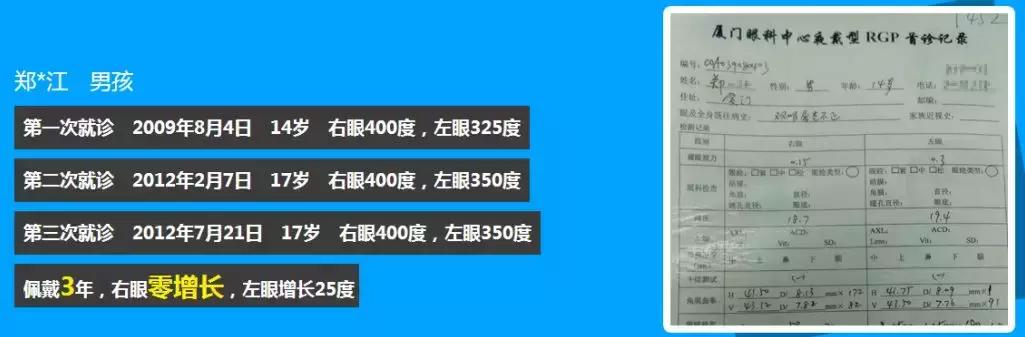 角膜塑形鏡