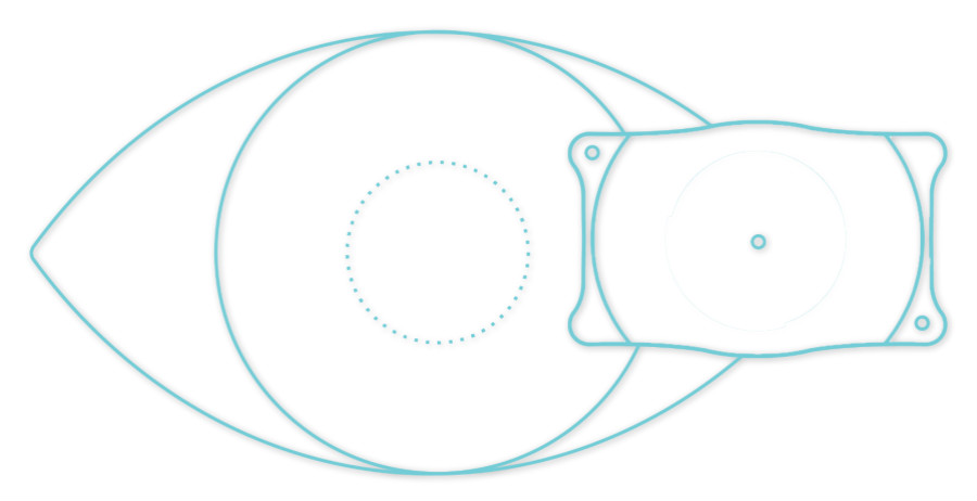 ICL晶體植入術費用