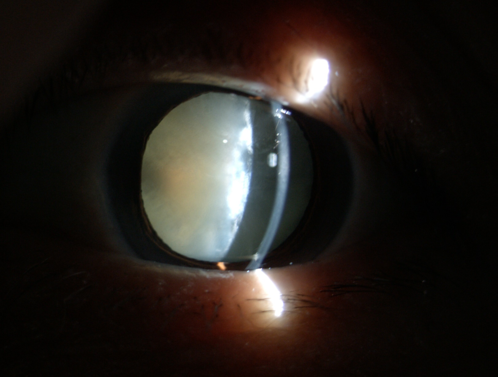 老年性白內(nèi)障