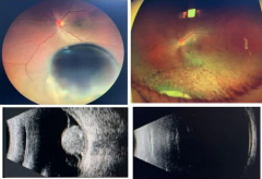 以為只是眼花，竟查出眼內(nèi)惡性腫瘤！50歲男子及時(shí)就醫(yī)后，獲“保眼”治療機(jī)會(huì)！